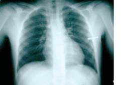 6 anterior rib visible on the X-Ray above the diaphragm