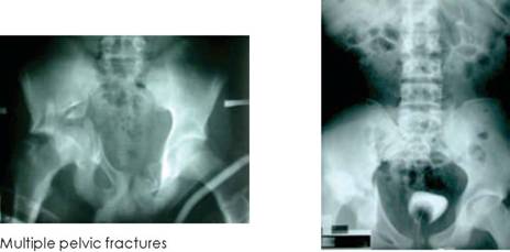 Aceabular fracture right hip