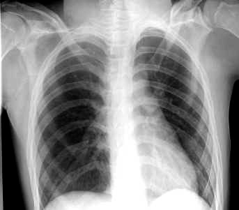 Adult chest x-ray showing arched ribs