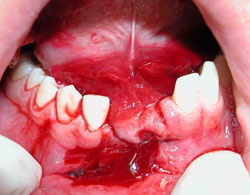 Avulsion of 2 lower incisors