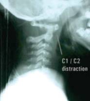 C1/C2 distraction