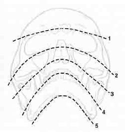 Campbell's and Trapnell's lines