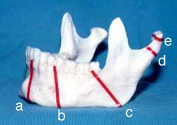 Common sites of mandibular fractures