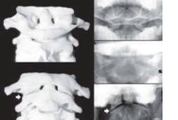 Examples of odontoid fractures