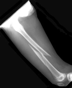 Femur fracture