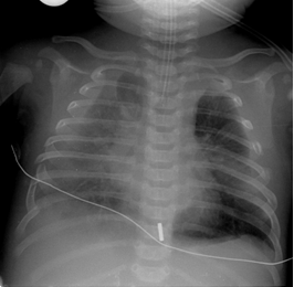 Flail chest with pulmonary contusion