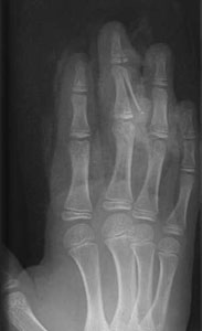 Fracture of middle finger