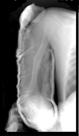 Humerus shaft fracture