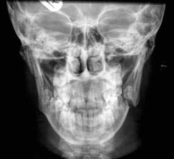 Left angle mandibular fractures