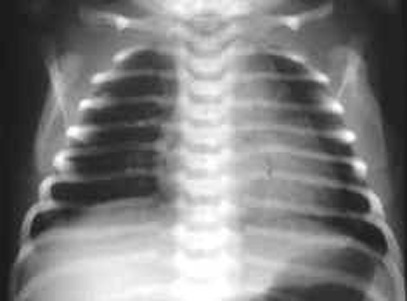 Neonate chest x-ray showing flattened ribs