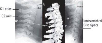 Normal lateral c-spine film Od odontoid peg