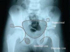 Normal pelvis