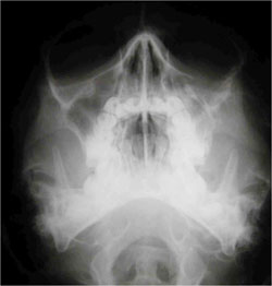 Occipitomental x-ray