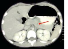 Pancreatic injury