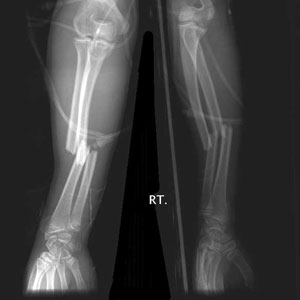 Radius and ulna fracture