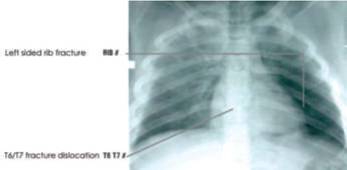 Right haemothorax