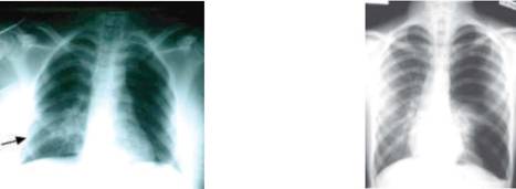 Right lower lung contusions Left-sided pneumothorax