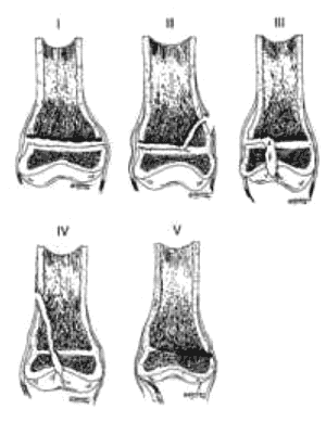 Salter Harris classification of fractures