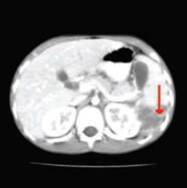 Splenic rupture