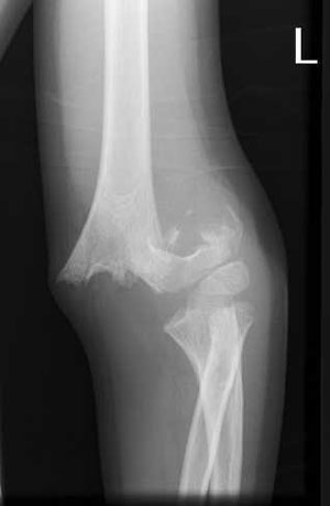 Supracondylar fracture