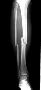 Tibial fracture
