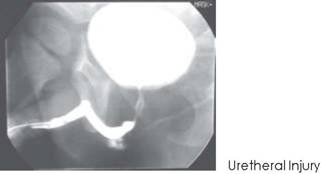 Urethreral injury