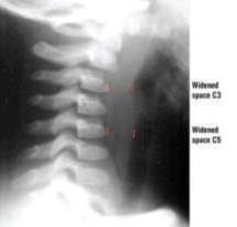 Widened soft tissue spaces