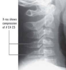 X-ray shows compression # C4 C5