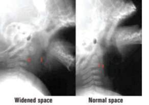 X-rays of the same infant