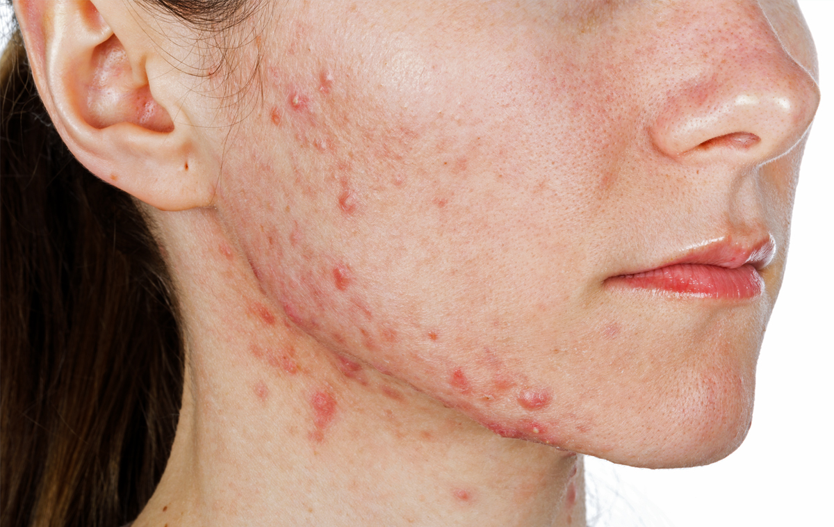 White female teen with cystic acne