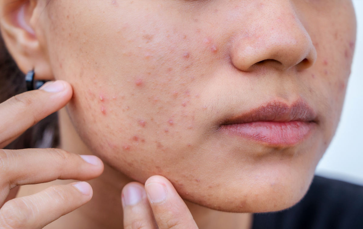 Asian female teen with acne