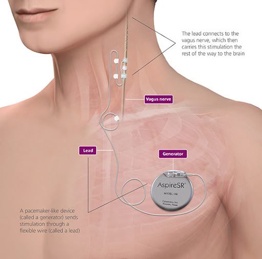 Placement of vagus nerve stimulation device. As illustrated in the